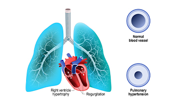 pulmonary hypertensio a progressive lung disease